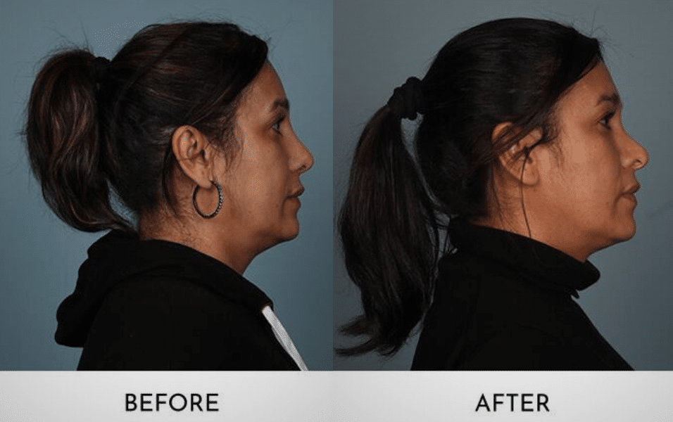 DCF Rhinoplasty: Understanding the Procedure