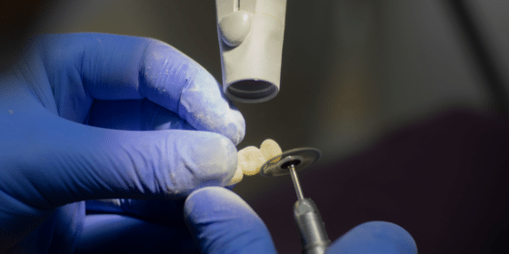 How to Replace Lost Teeth with Dental Implants in Albania