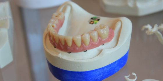 Preparing for Dental Implants A Patient's Guide