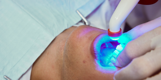 Professional Teeth Whitening: Is It Worth the Cost?