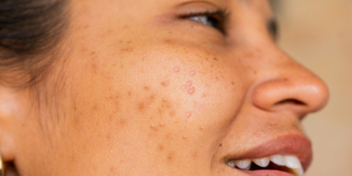 Milia to Clogged Pores: Identifying & Treating Tiny Bumps