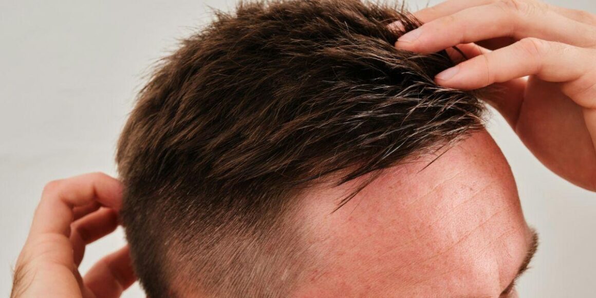 What Is Hair Restoration Surgery? Costs, Process, and Results